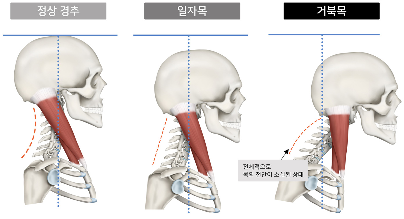 일자목과 거북목