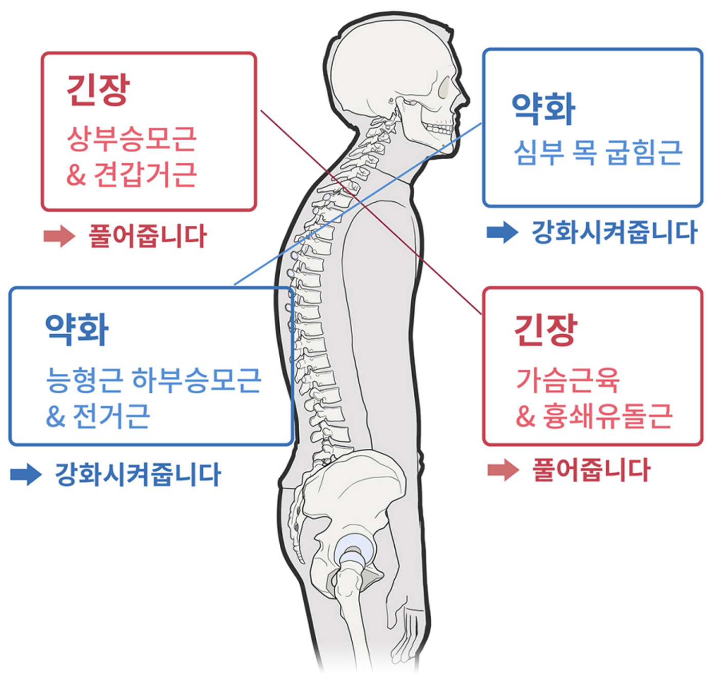 상부교차증후군