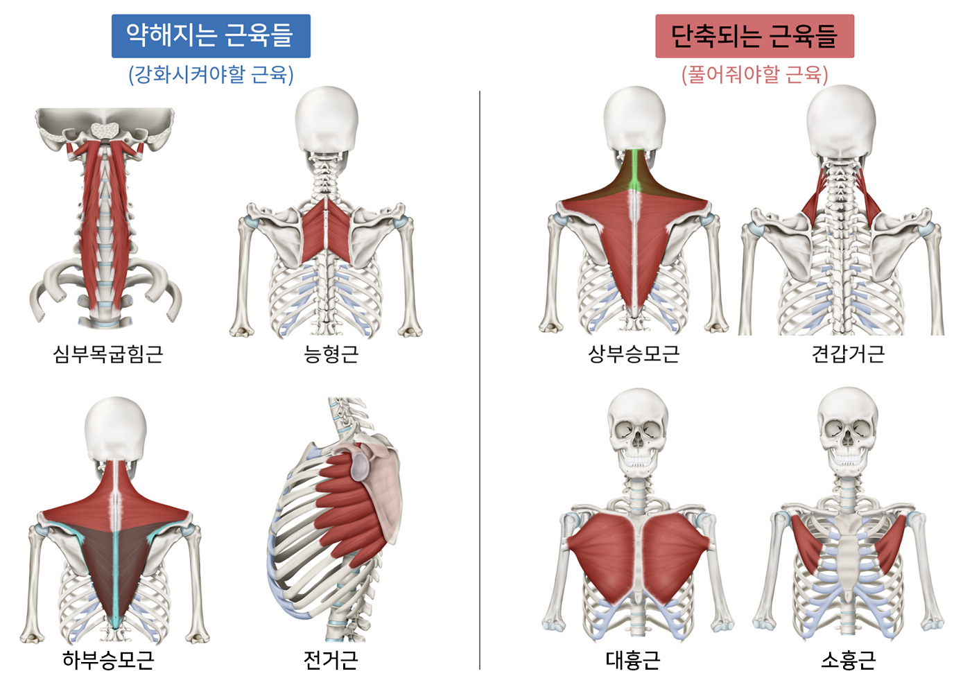 상부교차증후군