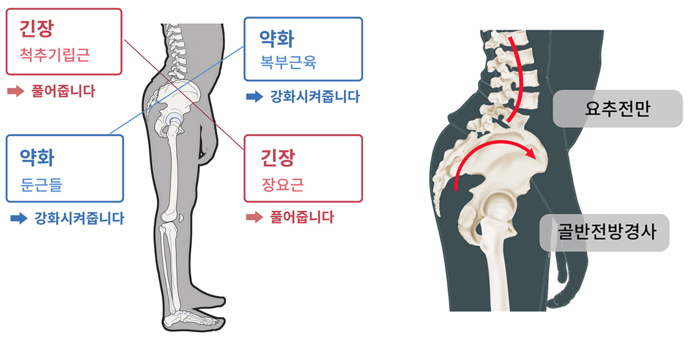 하부교차증후군