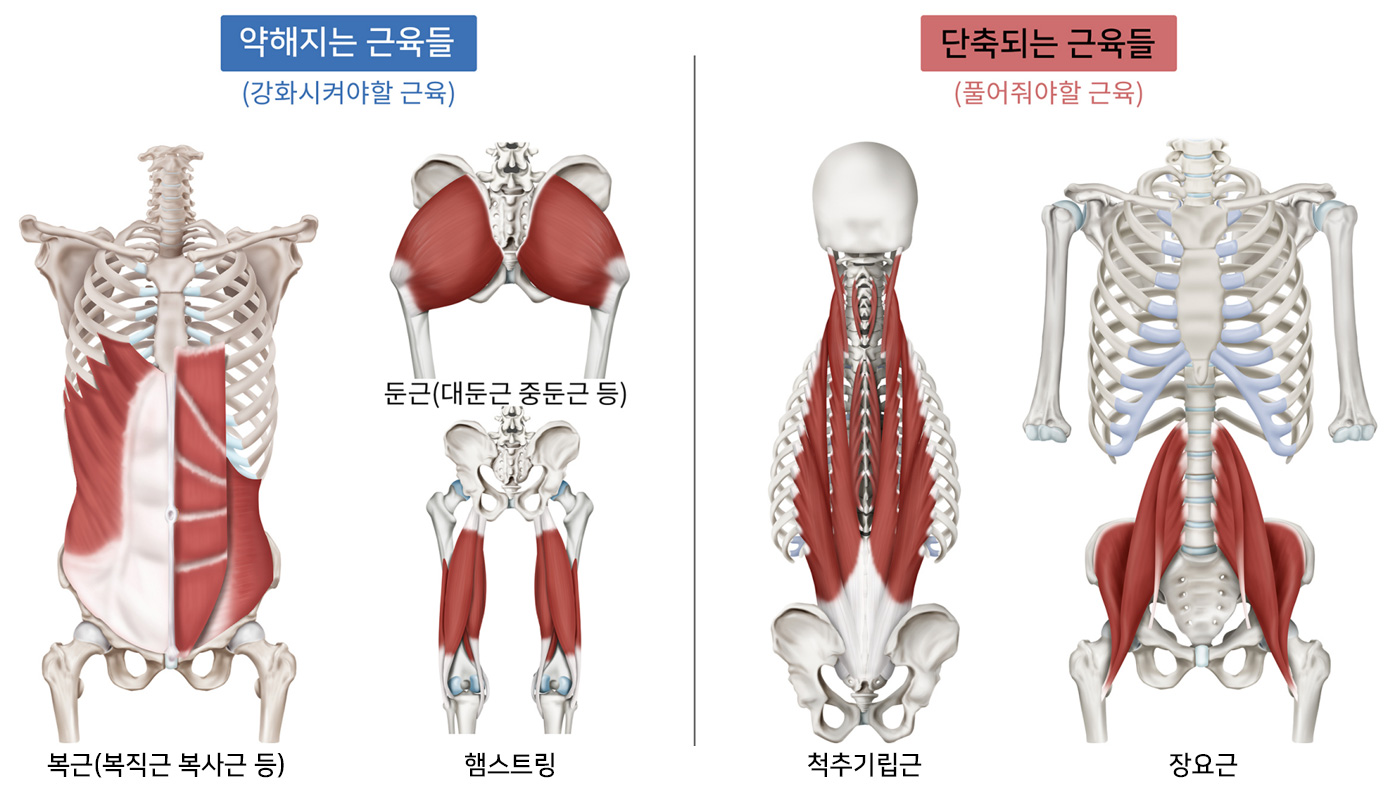 하부교차증후군