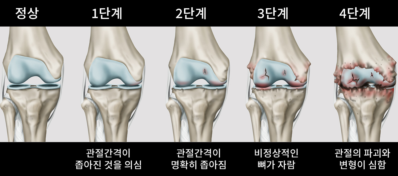 무릎퇴행성관절염