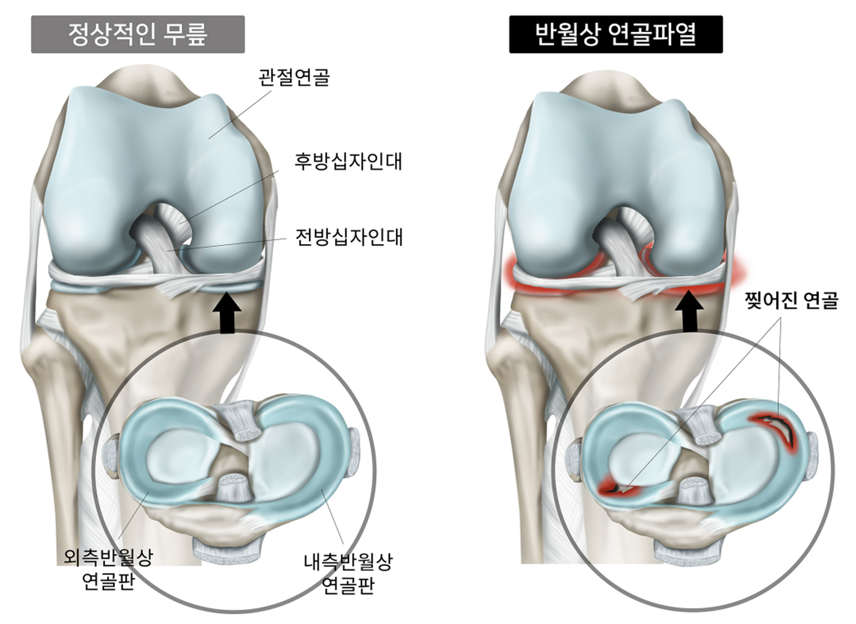 반월상연골파열