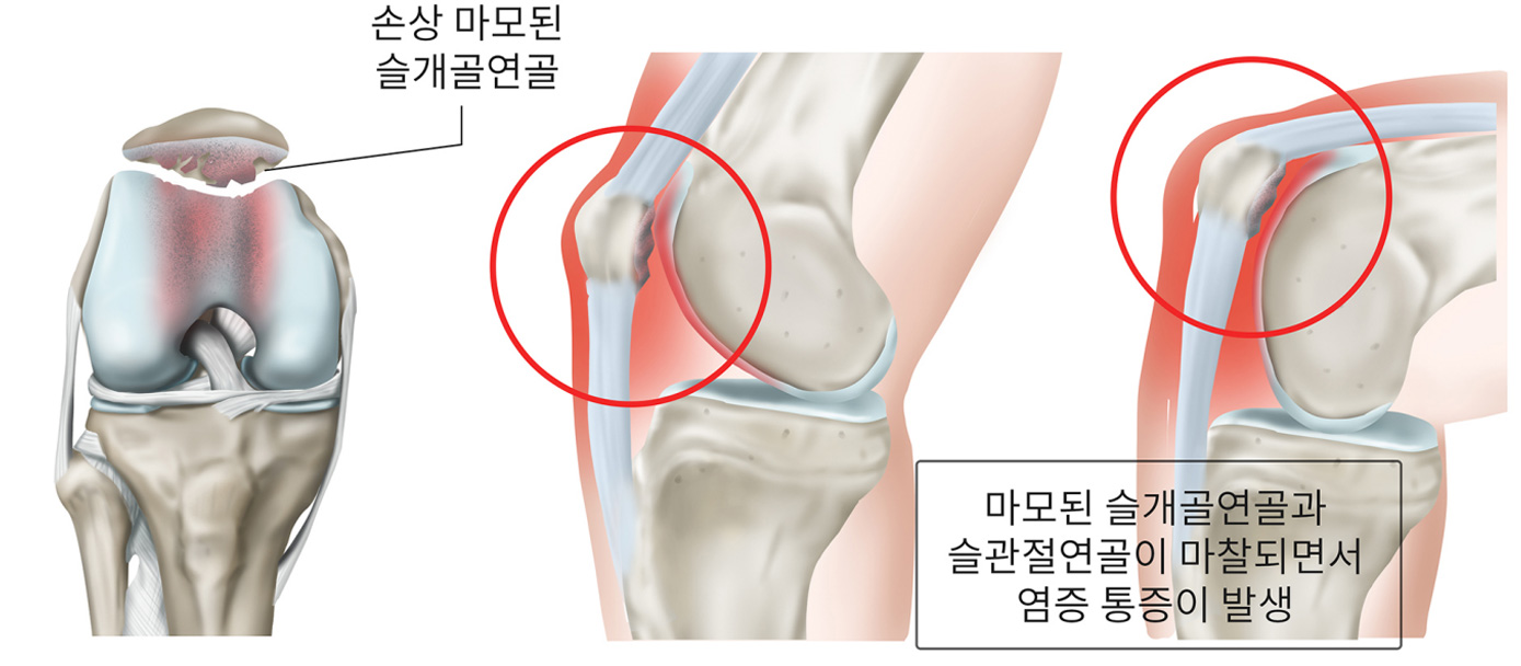 슬개골연골연화증