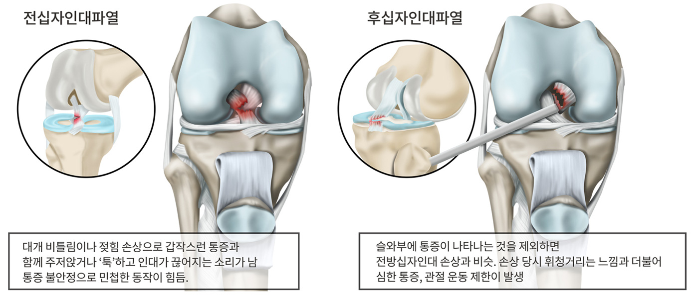 무릎십자인대파열