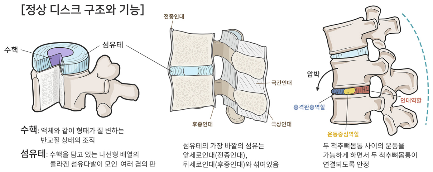 허리디스크