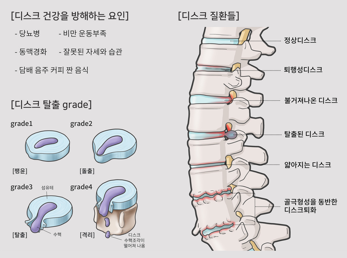 허리디스크