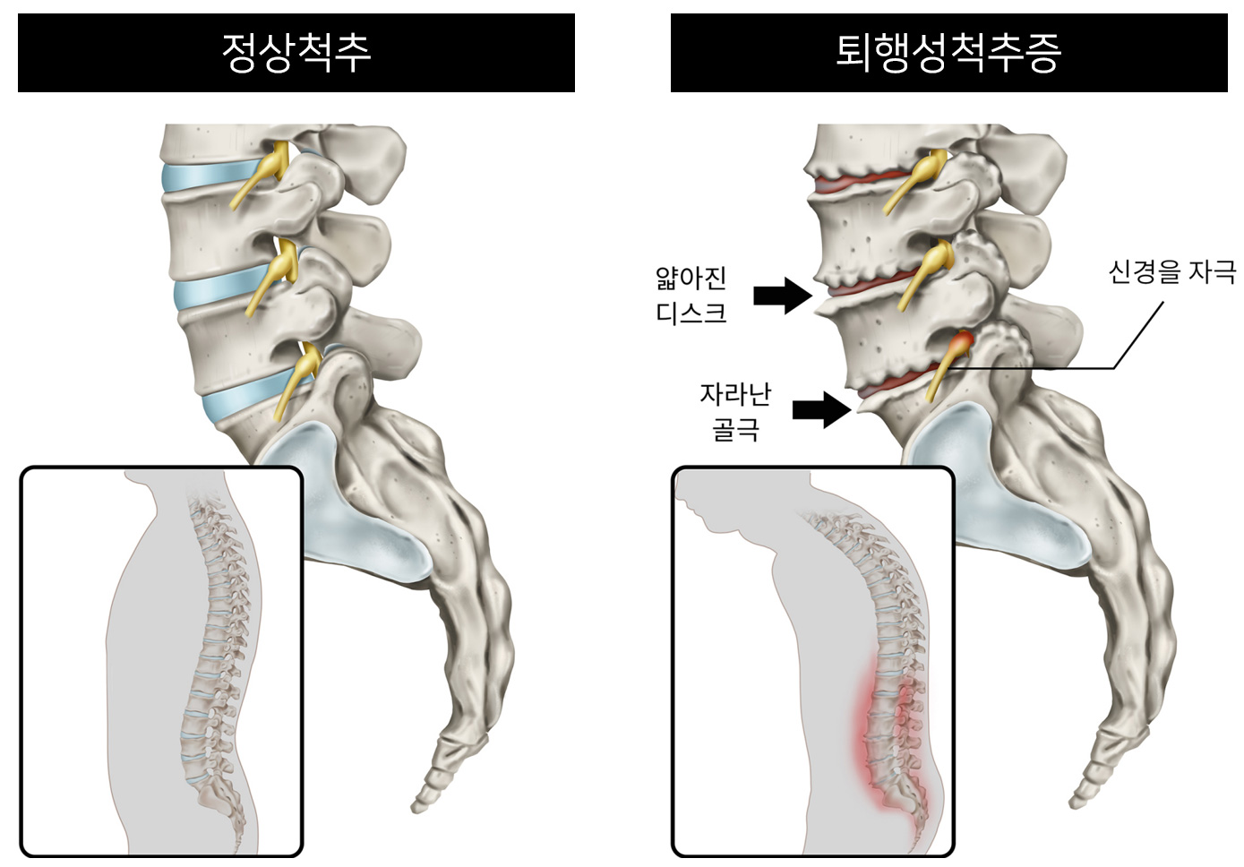 퇴행성디스크