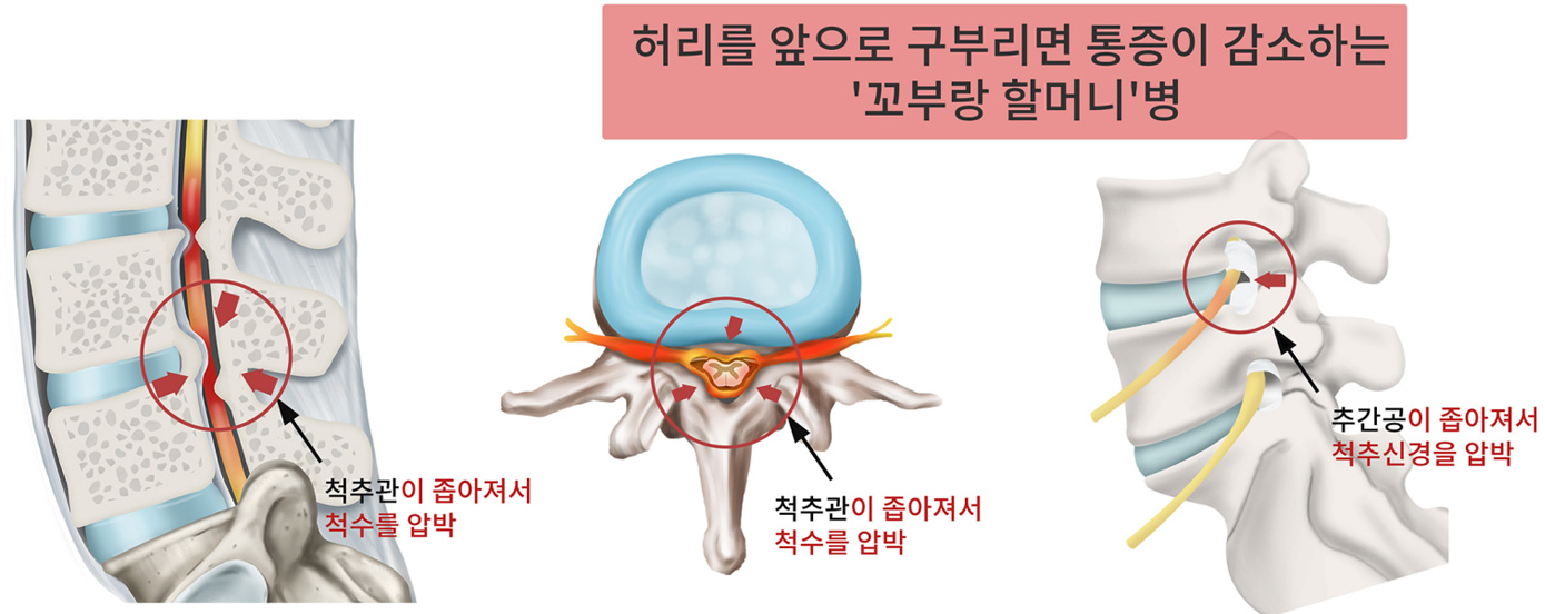 척추관협착증