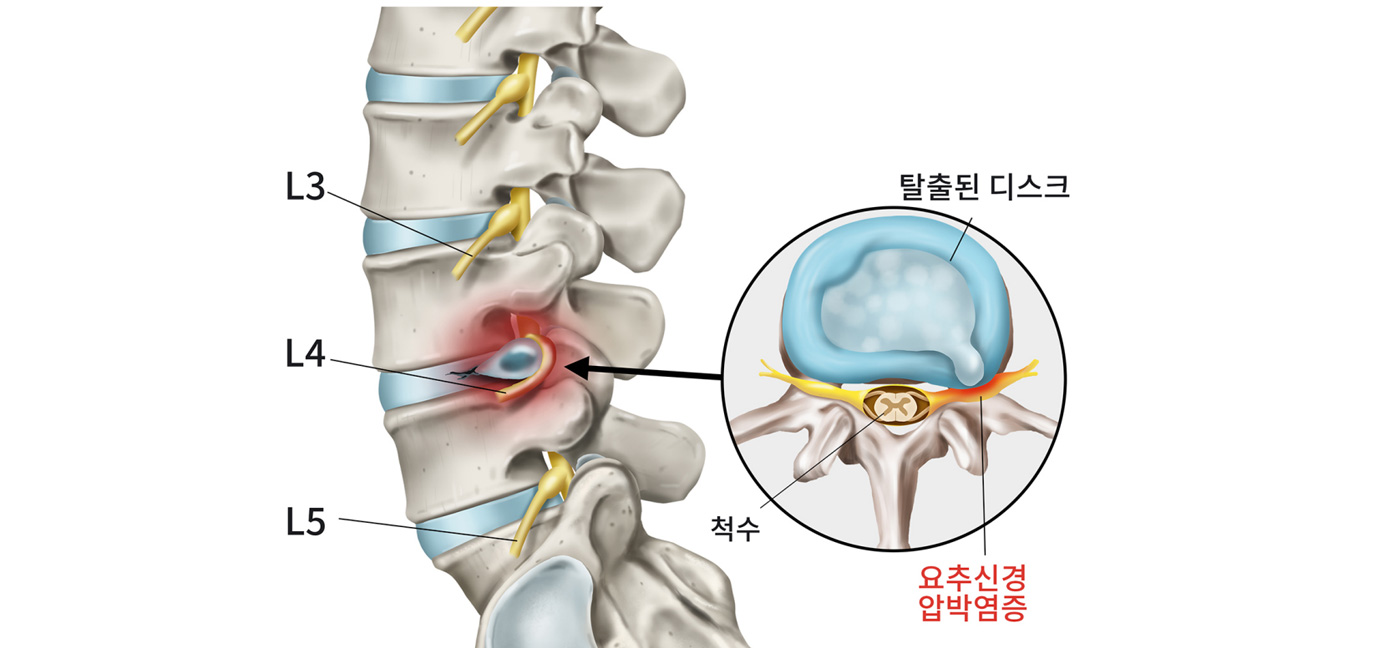 허리디스크