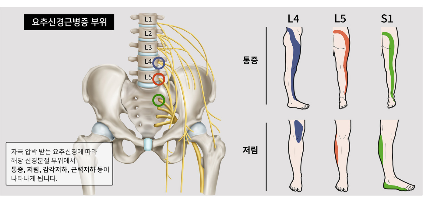 허리디스크