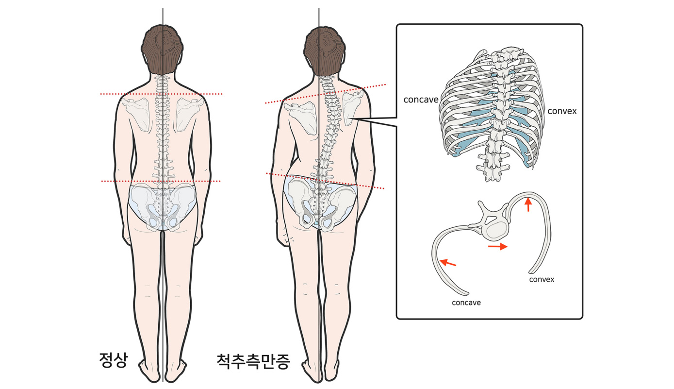 척추측만증