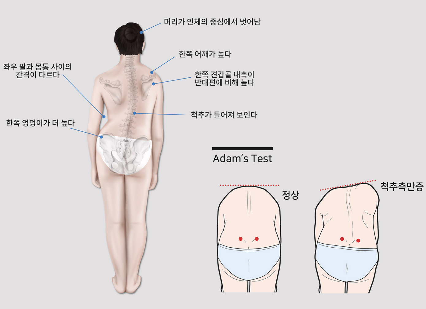 척추측만증