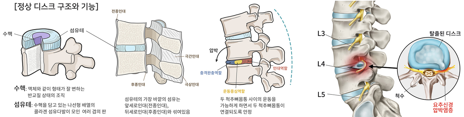 허리디스크