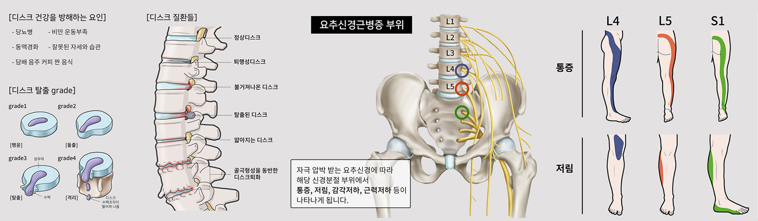 허리디스크