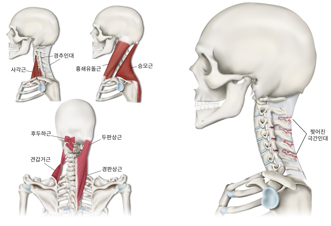 경추의 염좌