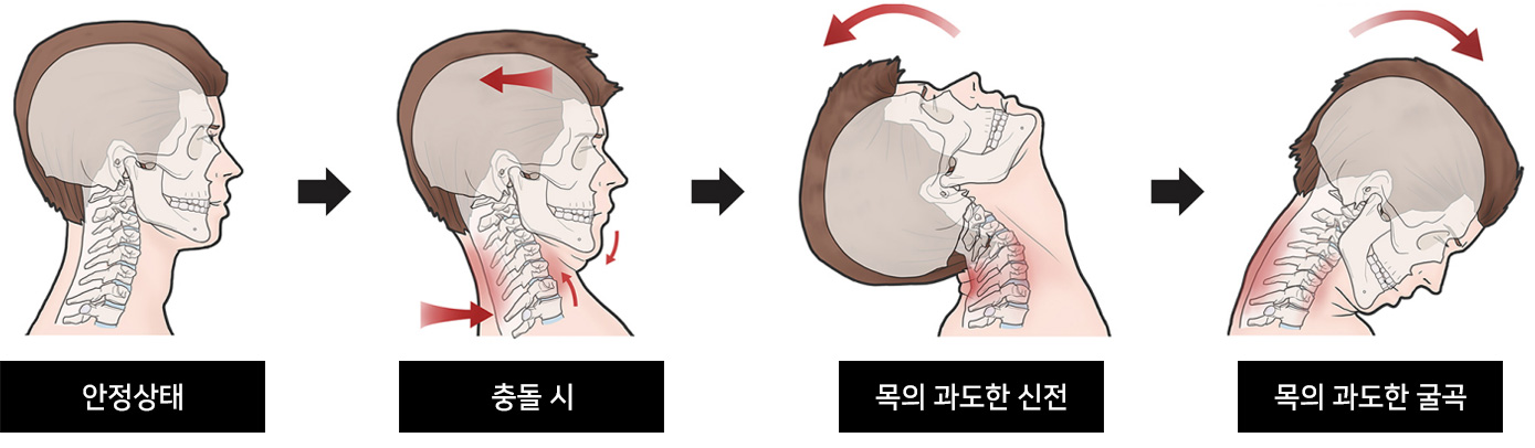 경추의 염좌