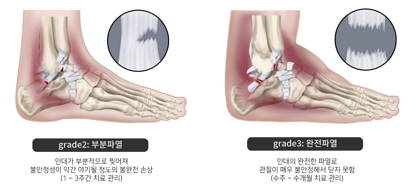 발목염좌