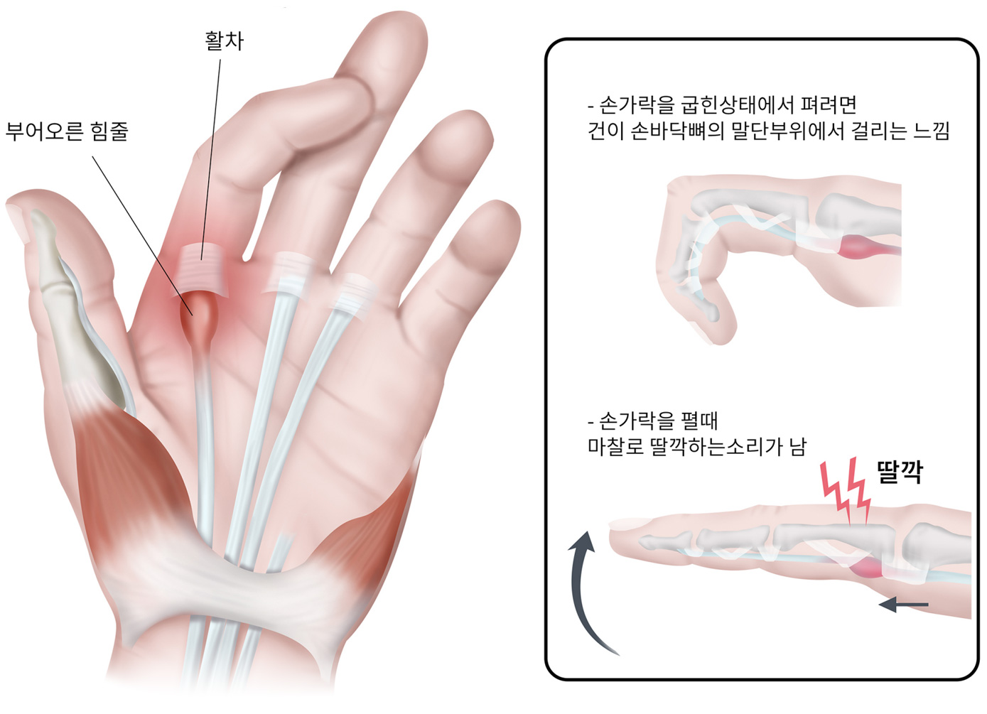 방아쇠수지