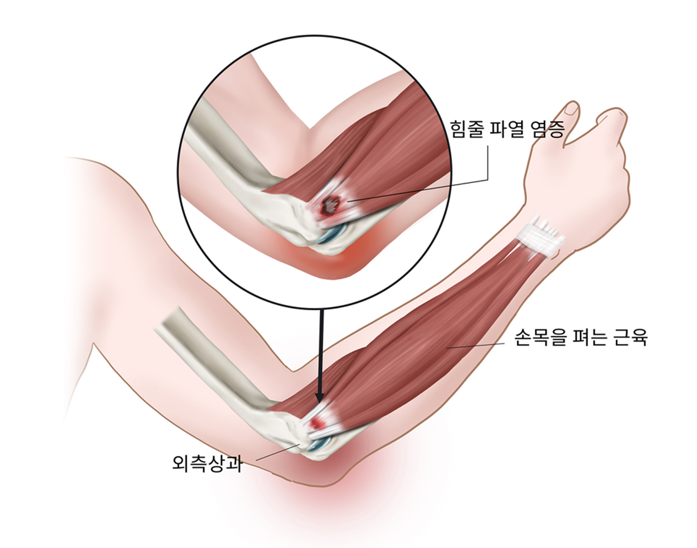 테니스엘보