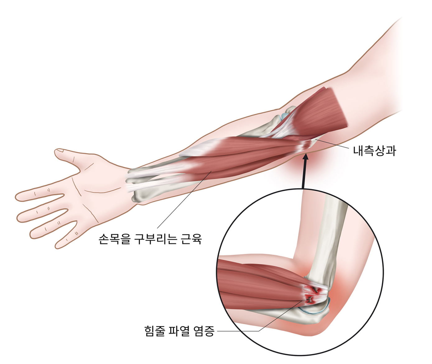 골프엘보