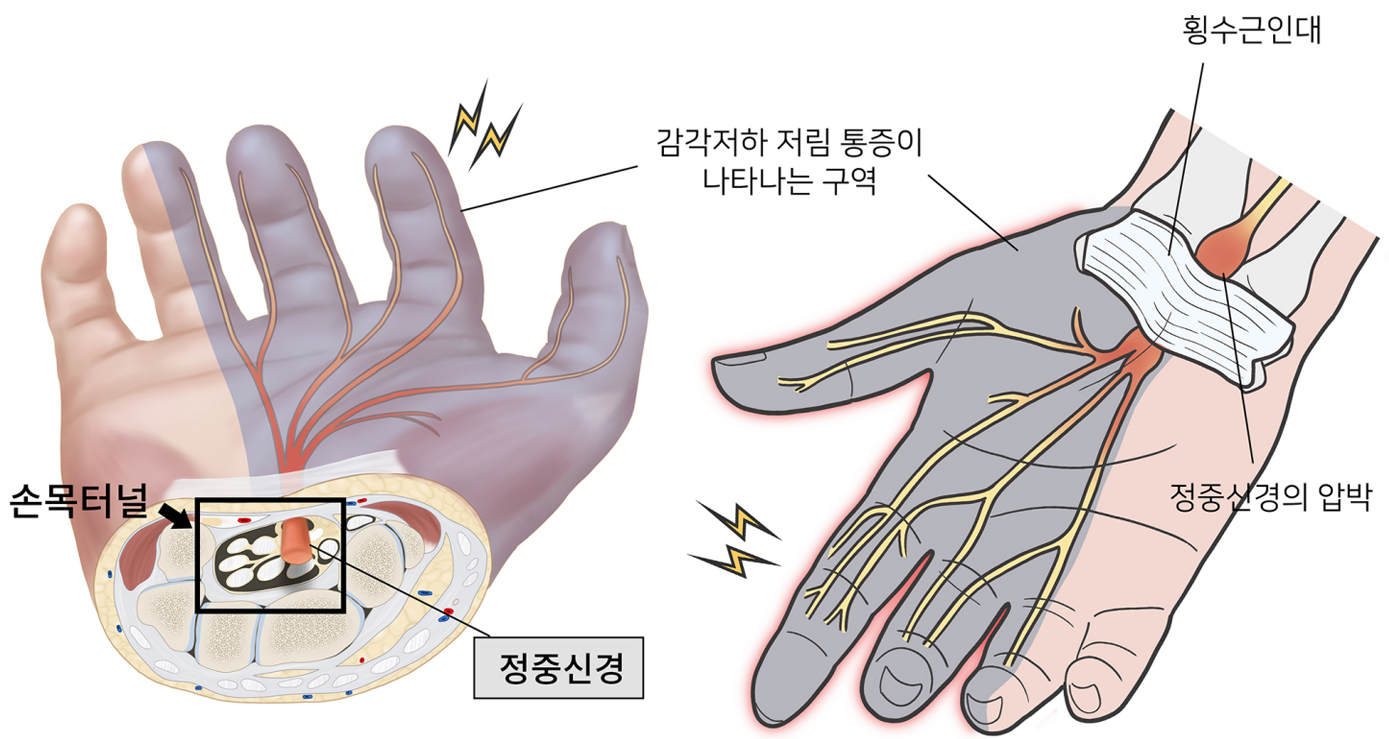 손목터널증후군