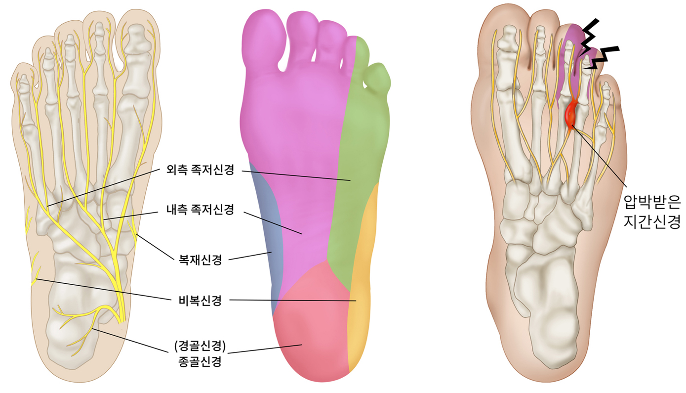 지간신경종