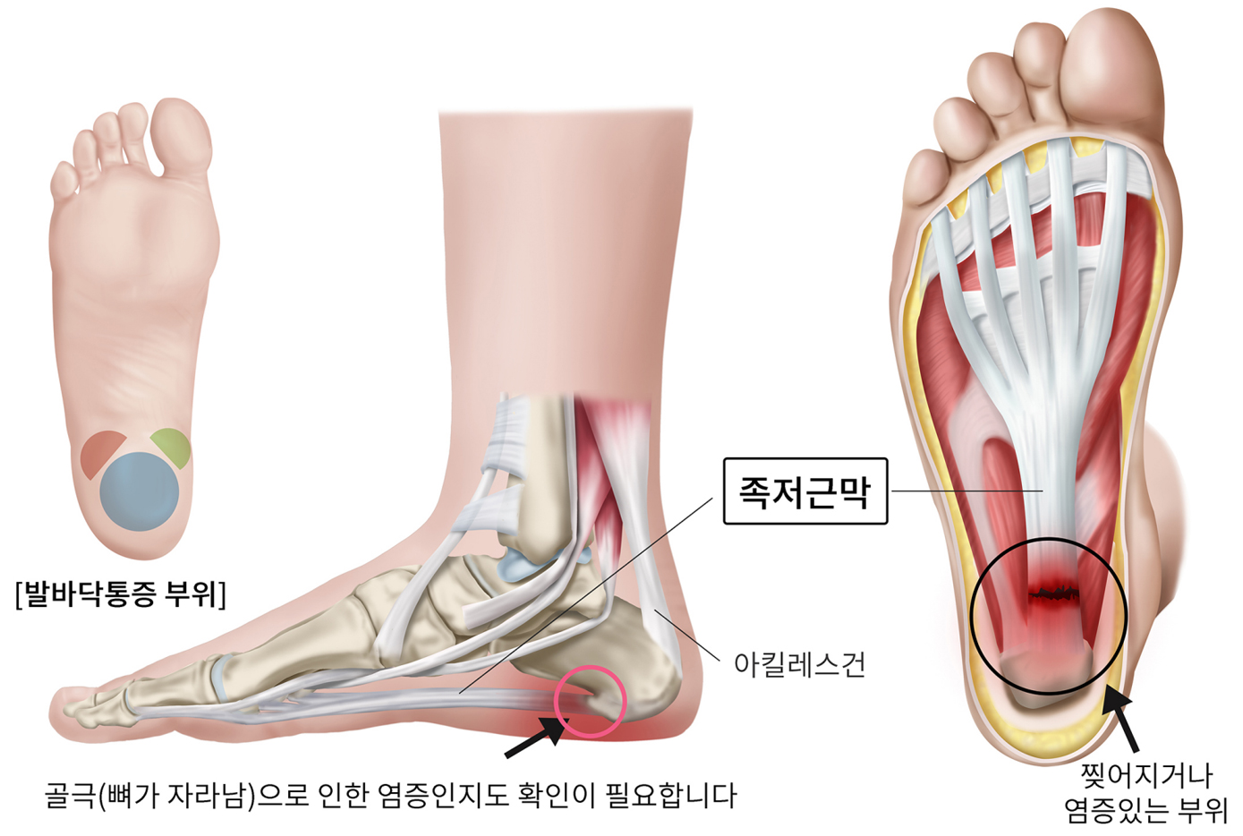 족저근막염