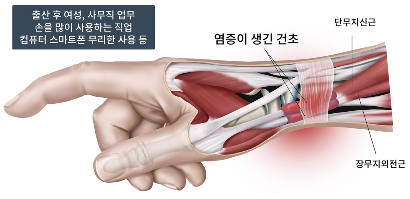 손목건초염