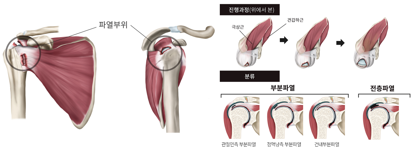 회전근개파열