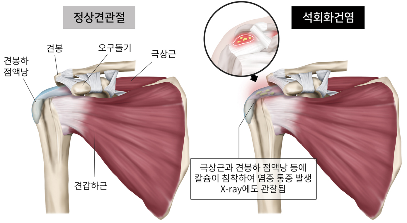 석회화건염