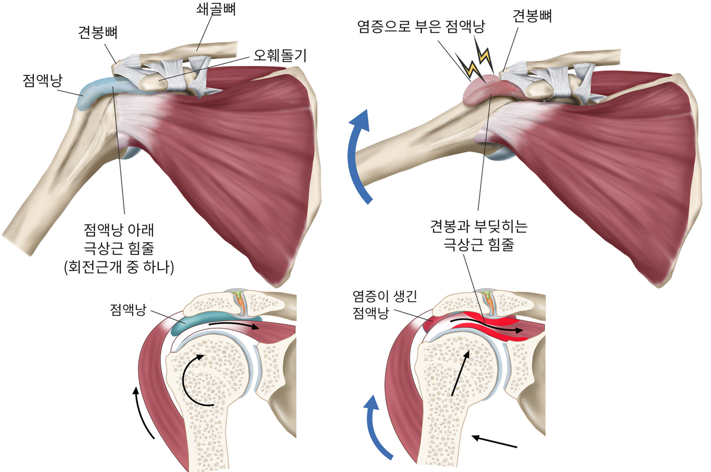 어깨충돌증후군